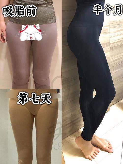 广州艺星的大腿吸脂项目有哪些优势？