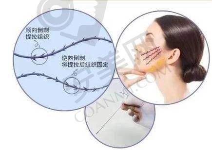 25800元起的面部埋线提升能达到什么成效？