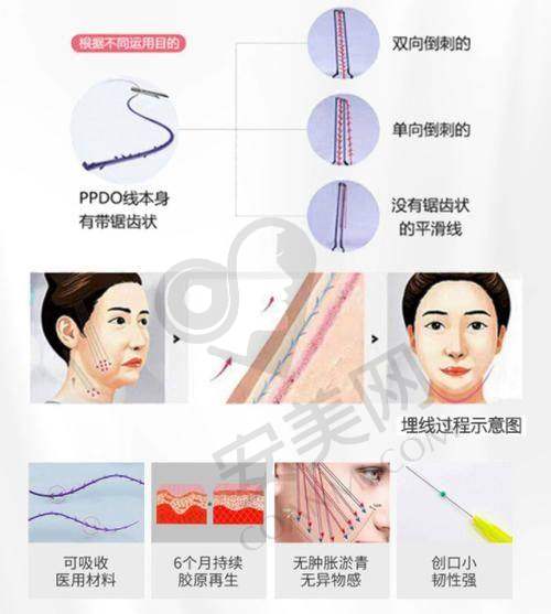 什么是面部埋线提升？