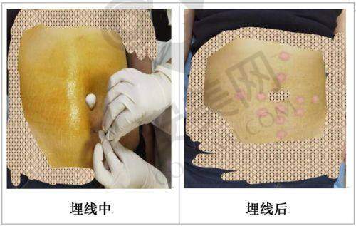面部埋线提升有风险吗？