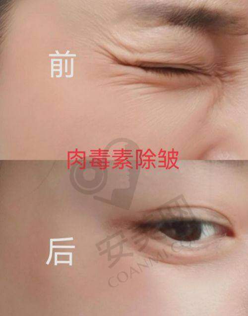 深圳富华的除皱针有哪些优势？