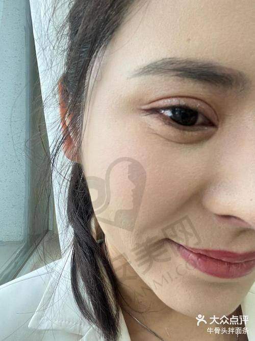 除皱针祛鱼尾纹的原理是什么？