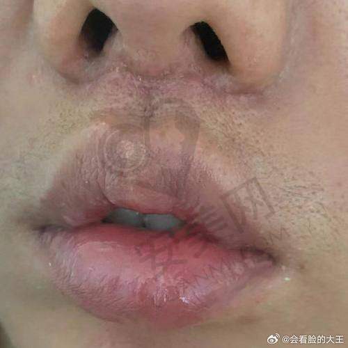 卢浩锵 | 广州医 科 大学附属第一医院 - 皮肤科