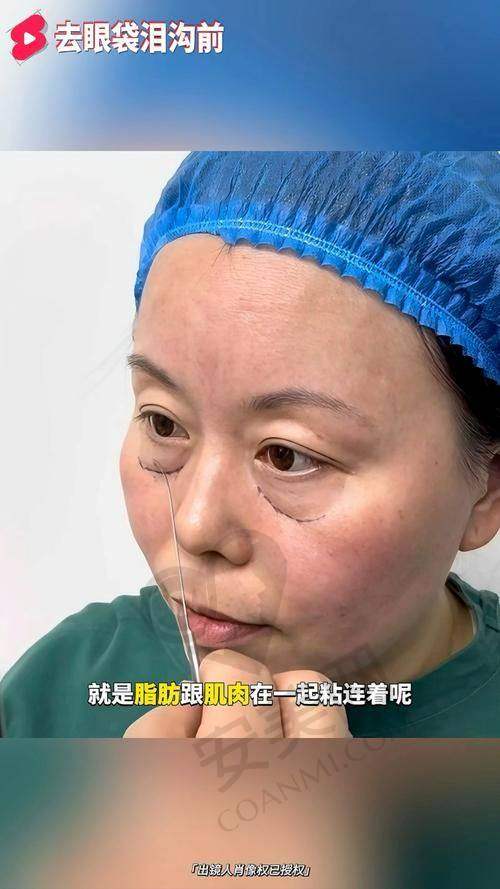 去广州曙光整形医院祛眼袋，就诊流程是怎样的？