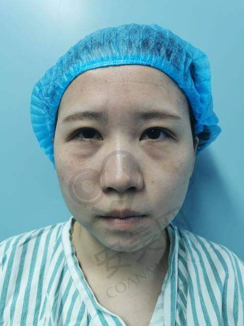 广州健丽去眼袋医院的服务质量怎么样？