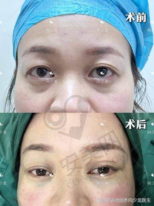 王杨医生打造卧蚕的成效怎么样？