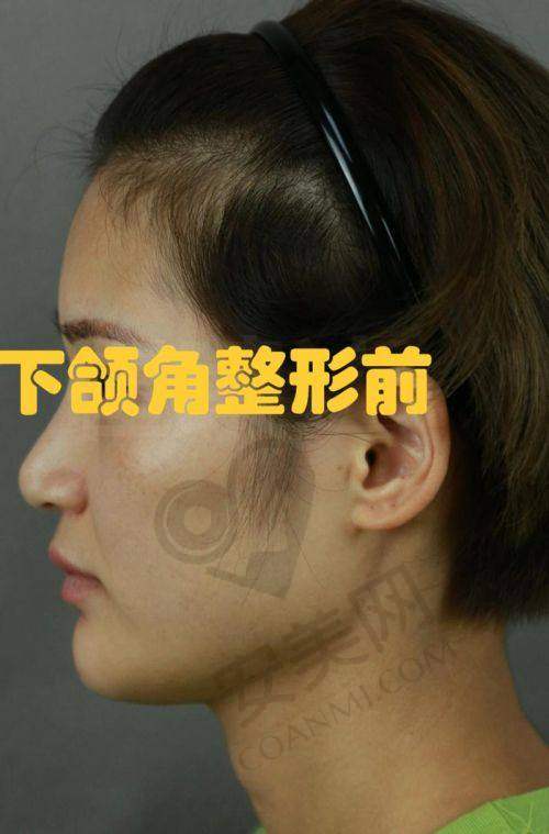 重庆松山朱乐林下颌角磨骨手术价格：3W元起的性价比之选