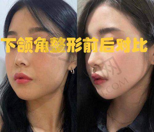 选择重庆松山朱乐林下颌角磨骨手术的优势