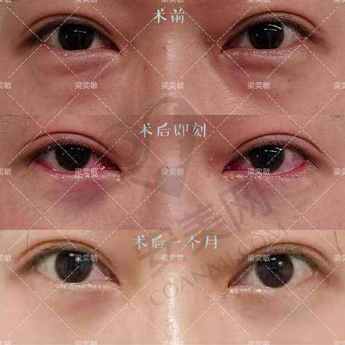 广州健丽去眼袋医院的医生团队专精吗？