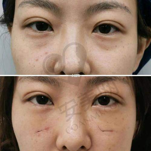 手术过程的顺利与术后的精心护理