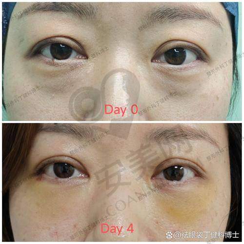 郑州人都找王杨医生做眼袋修复的原因