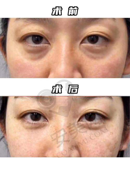 广州健丽去眼袋医院的后续保护服务完善吗？