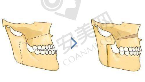 矫正过程中需要注意什么？