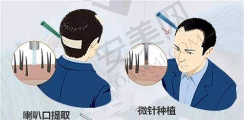 无锡百年植发医院与其他植发医院相比有哪些优势？