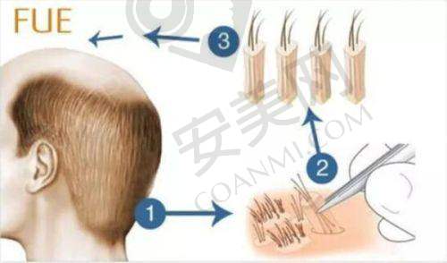 想了解无锡百年植发医院怎么样？看这里，专业揭秘给你明确答案！ 