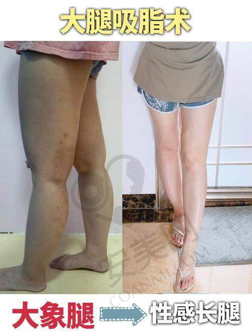 钟伟医生：大腿吸脂领域的骨干医生