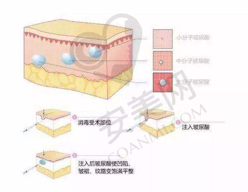 深圳婳美医院在注射抗衰方面有哪些保护？