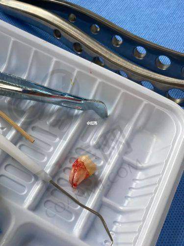 如何预约广州广大口腔超微舒适拔下颌常规智齿项目？
