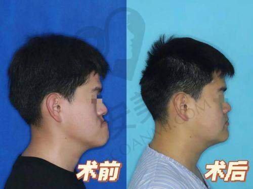 隐形矫正的体验如何？