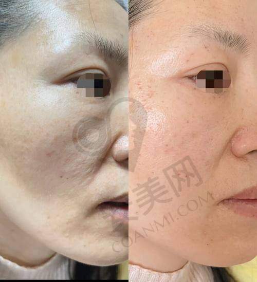 医生是如何为我制定皮肤激光美容方案的？