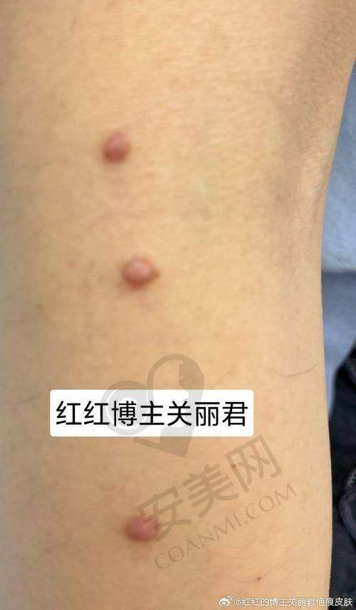 什么是增生疤痕，危害有哪些？