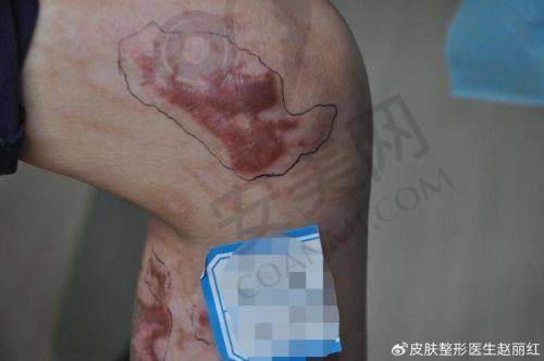 患者治疗增生疤痕的成效如何？
