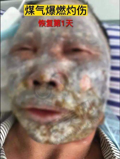 深圳鹏程医院疤痕科的优势及患者评价