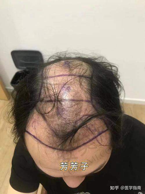 无锡百年植发医院的价格合理吗？