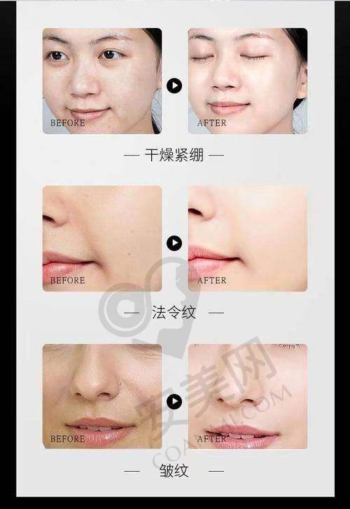 吉首星美医疗美容超声炮的成效能持续多久？