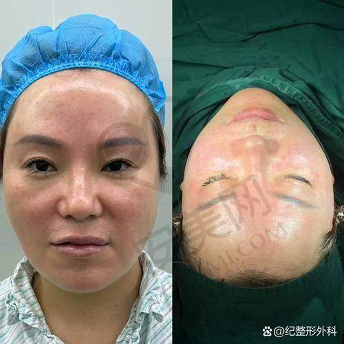 北京加减美黄寅守面部提升适合哪些人群？