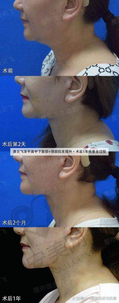 选择北京加减美黄寅守拉皮提升项目的理由