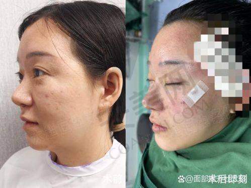 北京加减美黄寅守面部提升成效能维持多久？