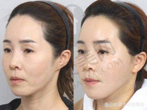 北京加减美黄寅守面部提升和其他医院的面部提升有什么区别？