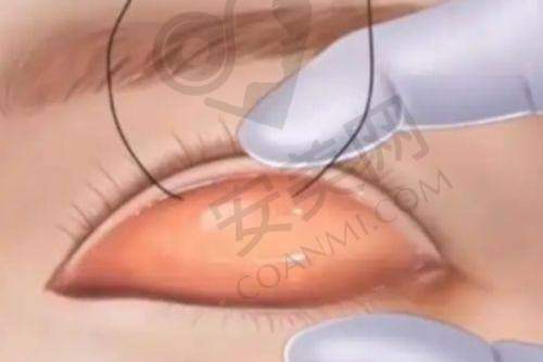 李在郁医生注射玻尿酸技术优势