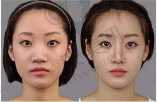 周珍艳医生：精细手术打造自然美眼，她的手术特点是什么？