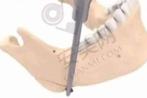 腹壁整形 22800 起能塑造理想腹部线条吗？