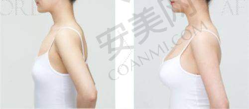 深圳美莱徐占锋医生擅长项目