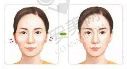 假体隆胸 17800 起的成效如何确保？