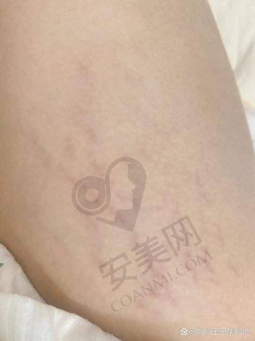 北京董先生修复妊娠纹有哪些成功实例？