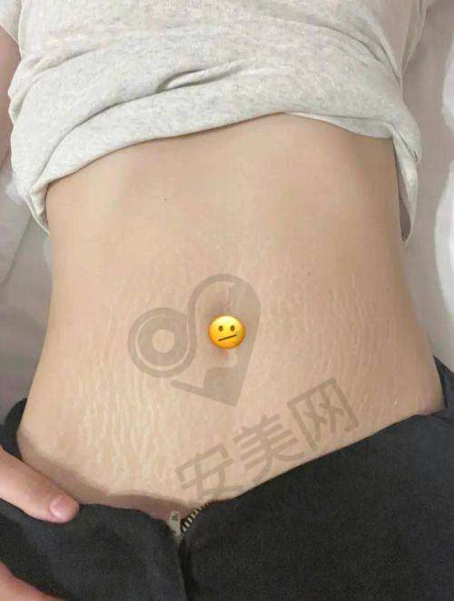 选择北京董先生修复妊娠纹有哪些保护？