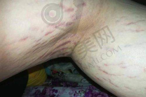 北京董先生修复妊娠纹价格分阶是怎样的？