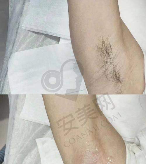 兰州梦想整形医院：多模式脱毛的优势