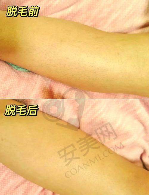 兰州皙妍丽整形：专属定制的脱毛体验