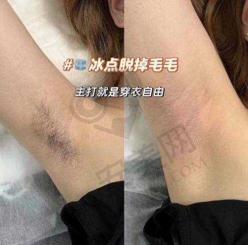 兰州崔大夫整形：超冰柔肤脱毛技术的魅力