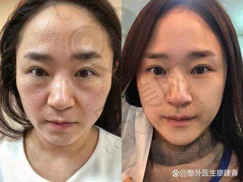 术后的修复情况如何？