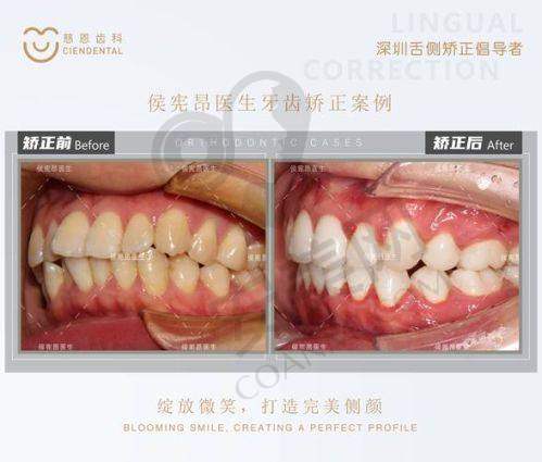 舌侧矫正：为何受到众多人的青睐？