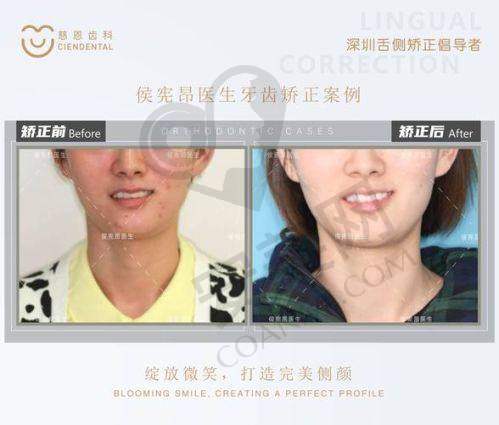 矫正过程：需要经历哪些阶段？