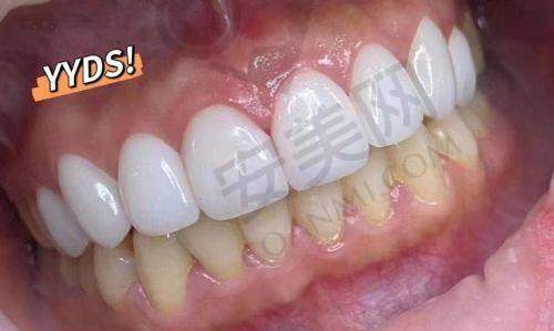 牙齿贴面美白方案是如何制定的？