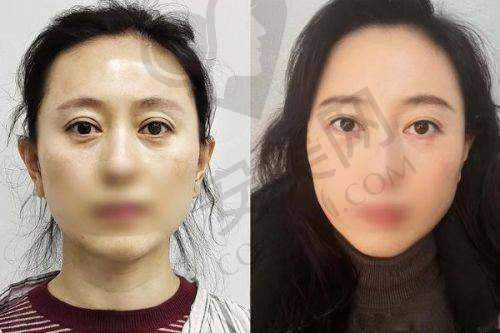 北京嘉禾双眼皮整形的价格合理吗？