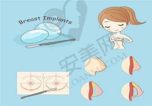 曼托水滴假体：隆胸材料的优质之选